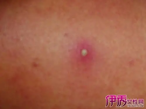 【图】阴毛囊炎症状硬疙瘩图合集 得此病该注意什么