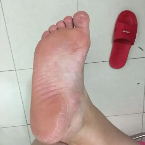 肝硬化脚先知,若脚上有3记号,说明肝不好