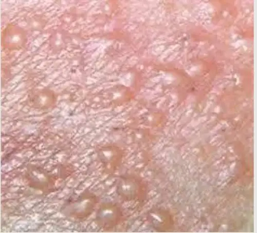 下体长了生殖器疱疹还能怀孕吗?