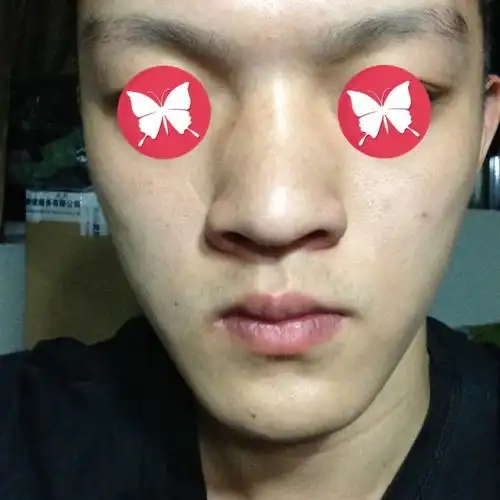 医生你好,我鼻梁两旁有明显的骨位凸出来.而且鼻大,怎救治