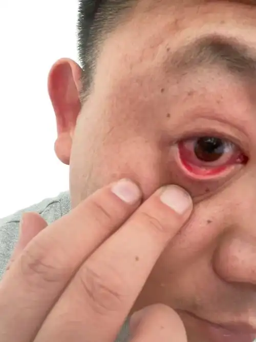 结膜结石手术 #结膜炎干眼症 这一天天的不是这上火就是那发 - 抖音