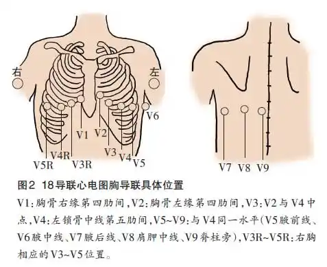 急性心肌梗死心电图表现