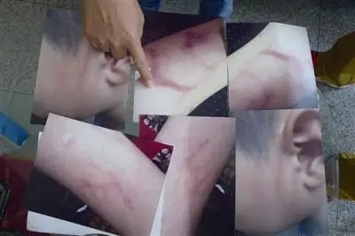 温州小学生作业没完成 脸和手臂被老师打淤青