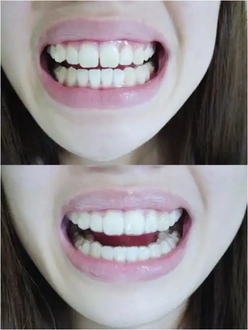 牙套是什么样子的图片