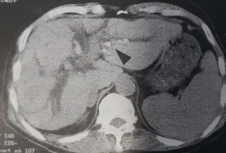 ct显示 肝内胆管多发高密度结石