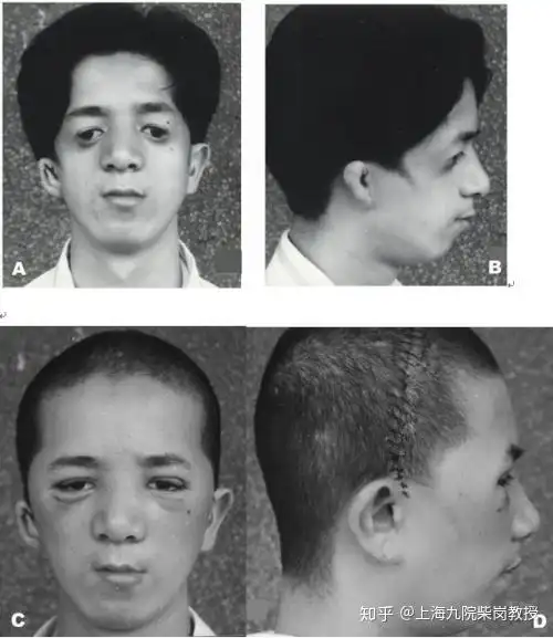 柴岗医生讲堂:矫正半面短小问题属于整形类范畴吗?