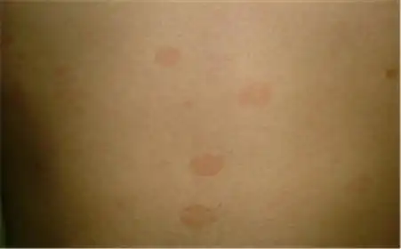 临床上如何诊断花斑癣