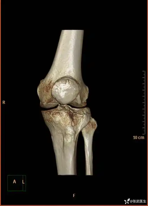 手术|胫骨平台骨折的手术治疗