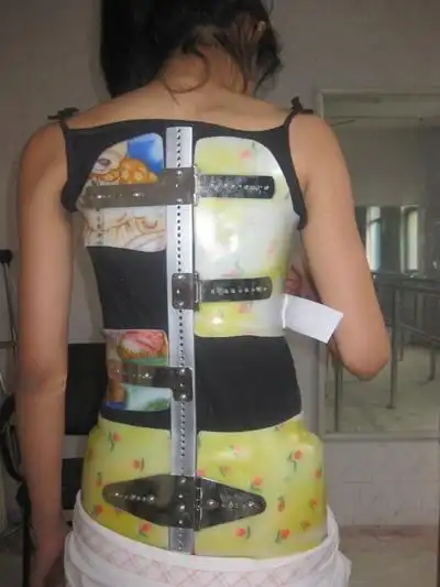 里昂组件式脊柱侧弯矫形器