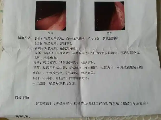 胃溃疡是常见胃病,希望去医院检查一下, 指导意见: 如果是胃溃疡引起