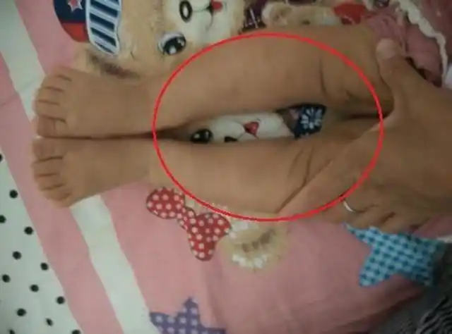 家长也可以自己检查一下,让小婴儿平躺仰卧,动作轻轻地拉直宝宝双腿