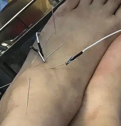 这是我针灸的脚