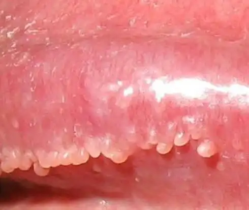 珍珠丘疹的概述