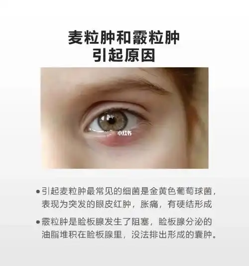 分不清麦粒肿和霰粒肿?看这篇就懂了90