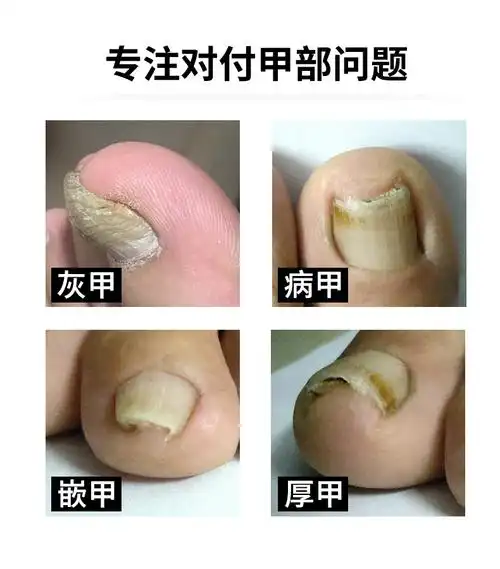 瑾宇修脚刀灰指甲专用指甲剪老人修甲工具斜口大码大口厚脚趾特修脚钳