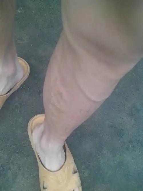 小小年级为什么会有小腿静脉曲张?求解?