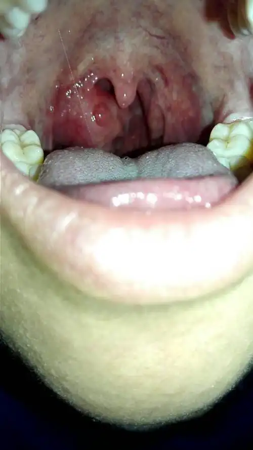 前段时间扁桃体发炎 后来去打了五天针 我觉得嗓子不疼了就没去打了