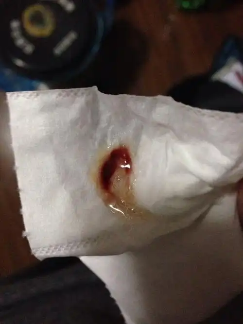 最近喉咙很痛,想吐痰,有时候痰里带血(如