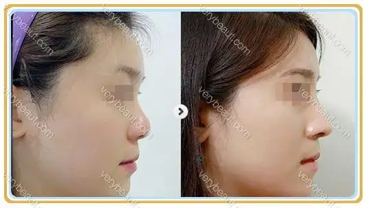 玻尿酸隆鼻前后对比