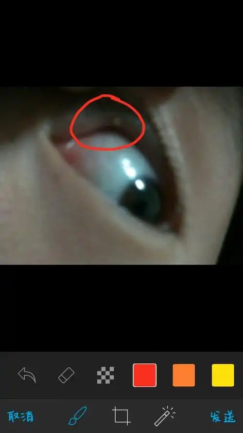 眼睛里面长了小肉粒,如图,没有感觉不痛不痒,这是什么东西,该怎么去掉