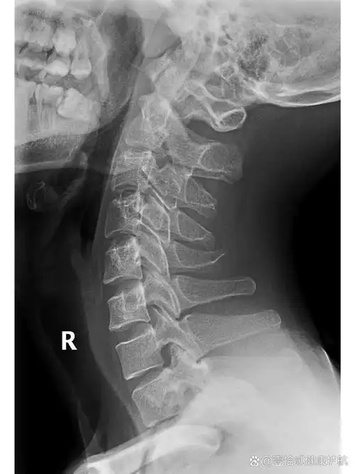 正常颈椎的曲线