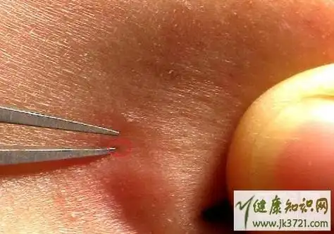 闭合粉刺一定要挤出来才会好吗,闭合性粉刺挤出来会好吗,闭合性粉