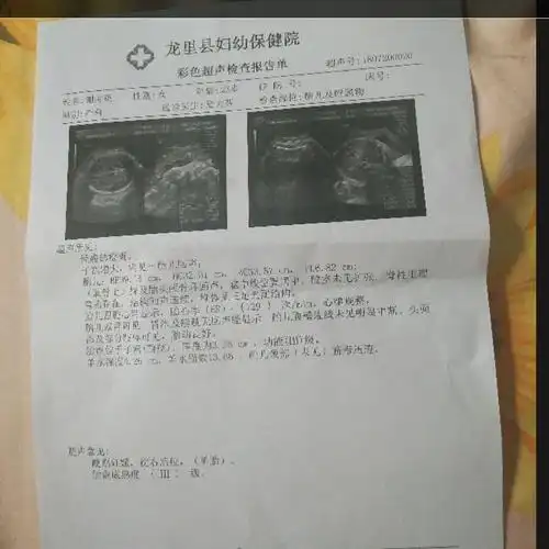 枕右后位是什么意思?