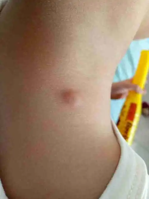 孩子肩膀上起个包,像是闷头但是一直不出头,好几个月了,不碰不疼,一碰