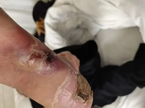 科普| 糖尿病并发症来了,预防要点要记牢!