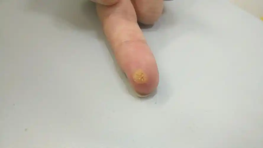 病毒疣16:寻常疣,最好的科普就是用成功的案例来展示! - 好大夫在线