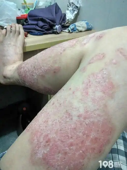 整条腿都是牛皮癣,到处看都没治好我该怎么办?