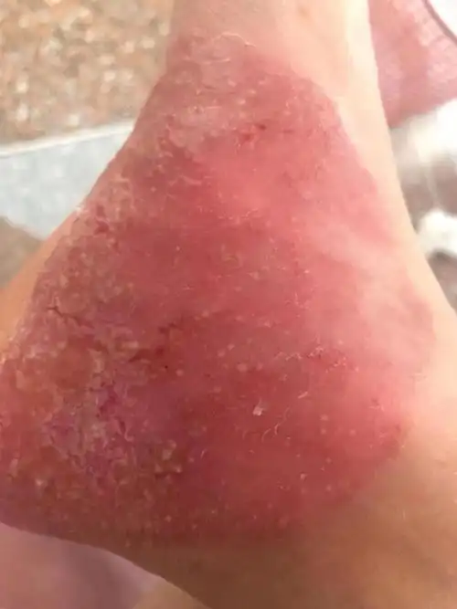 掌跖脓疱病…………排毒期结束…………快痊愈了#掌跖脓疱病  #掌跖