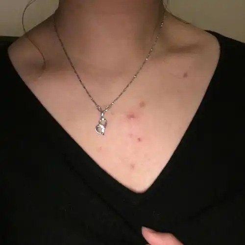 最近胸前长了些痘痘什么原因怎么办