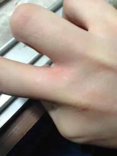 被两个多月左右的小狗抓伤了,留血了,狗没打过针,请问我需要打预防针