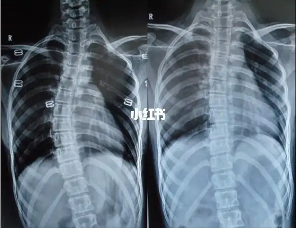 19年中秋节假期的时候吧体检查出脊柱侧弯,好像当时20多度,身上也没