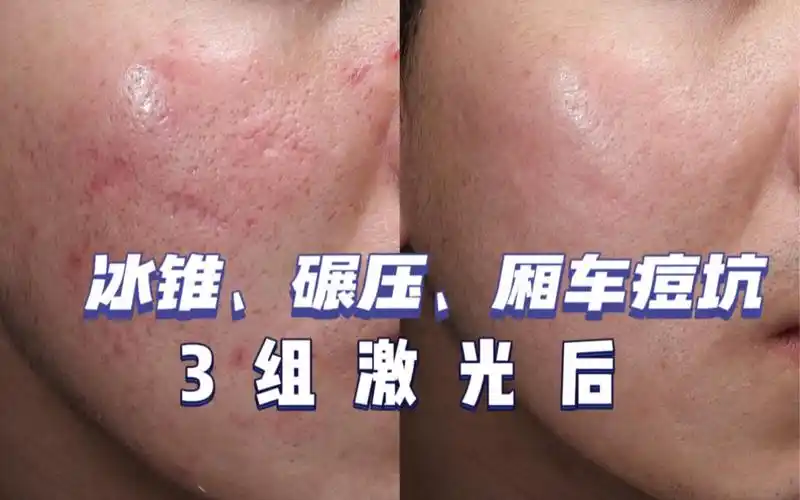痘坑修复,21年到23年做了3组点阵激光的变化