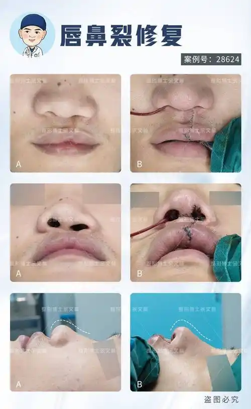 【案例分析】唇裂患者鼻孔一大一小不美观,想做手术修复_鼻翼_软骨