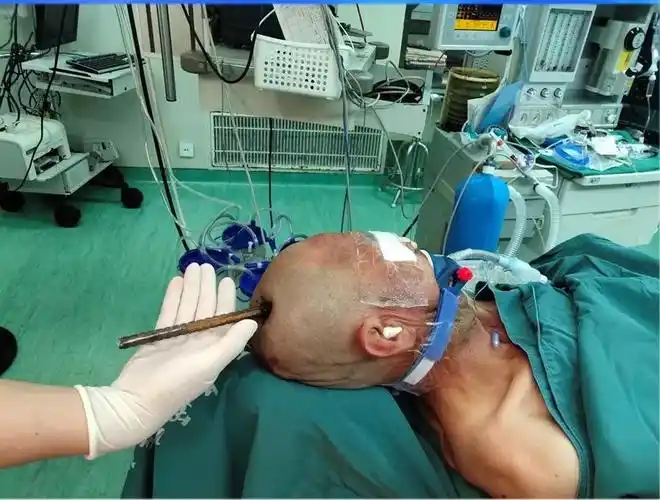 [案例解读]西京医院成功救治一名钢筋颅脑贯穿伤患者