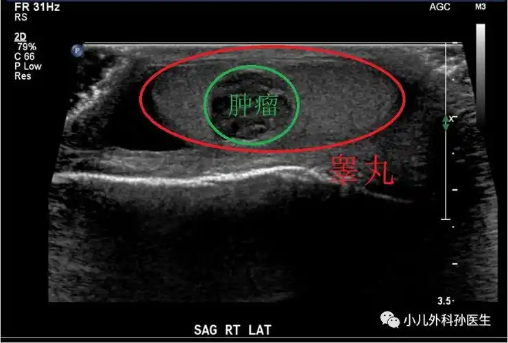 drsun蛋蛋的忧伤话说小儿睾丸肿瘤是男人就要学会做睾丸自检