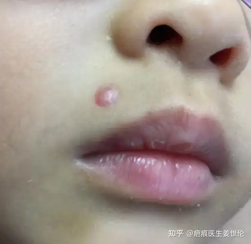 点痣后的疤痕增生如何修复? - 知乎