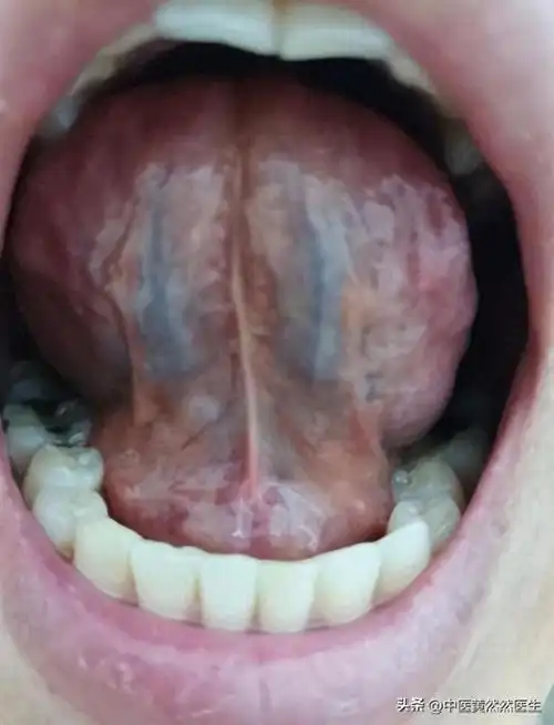 血瘀体质舌底下血管的4个形态你是哪一种呢