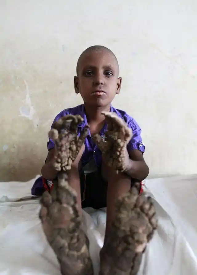 胆小慎入! 孟加拉国"树孩"手长树瘤