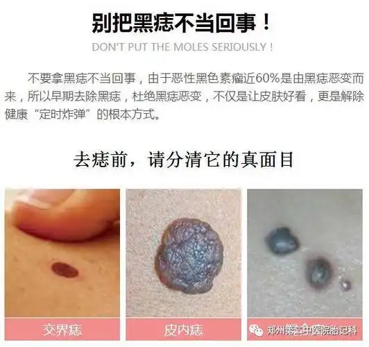 脸上黑痣能彻底去除吗?