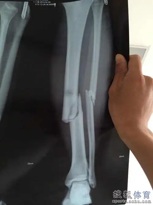 中泽小将双骨粉碎性骨折 重现鲁能悍将惨剧(图)