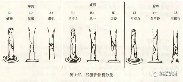 pilon骨折分类(累及胫距关节面的胫骨远端骨折)ruedi-allgower分型i型
