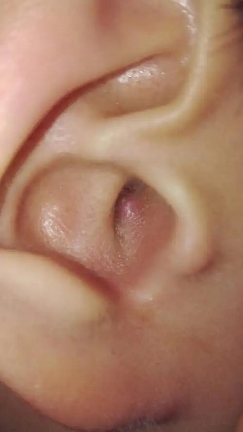 耳朵里长了个包,稍微按一下就疼的很,刚开始只是痒,后来长出来的,开始