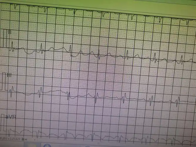 高频心电图证明,心肌损伤后qrs切迹增多;宽频心电图证明,fqrs与瘢痕有