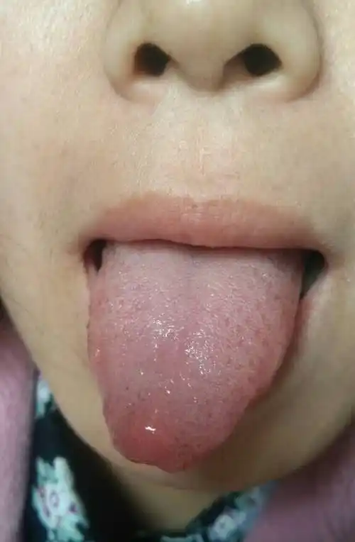 21. 脾胃有湿加肝郁;看不到舌根,精神紧张.