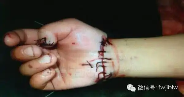 "后妈砍下孩子手扔进粪坑