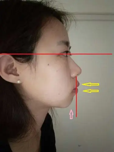 请问大家我是牙凸还是缺下巴,还是两者都有,现在如果急需矫正的话,是